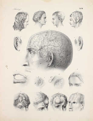 [Брунс В. Хирургический атлас. Наглядное описание хирургических заболеваний, инструментов, повязок и операций, необходимых для их лечения, составленное доктором Виктором Брунсом. Первый отдел. Мозг и оболочки]. Tübingen, 1854.